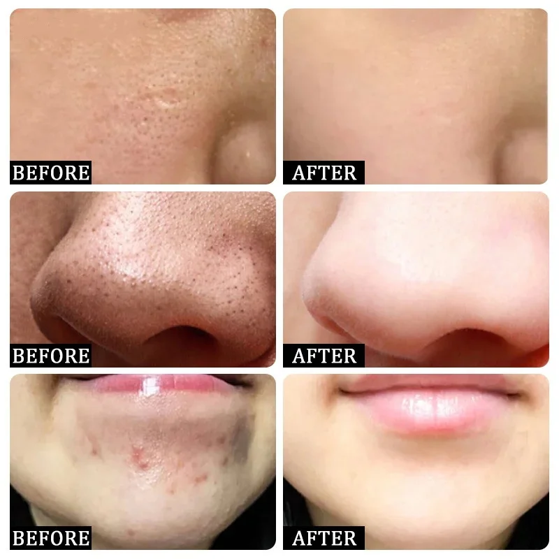Salicylsäure Poren Clearing Cr – Salicylic Acid Blackhead Remover Bewertung und Preis