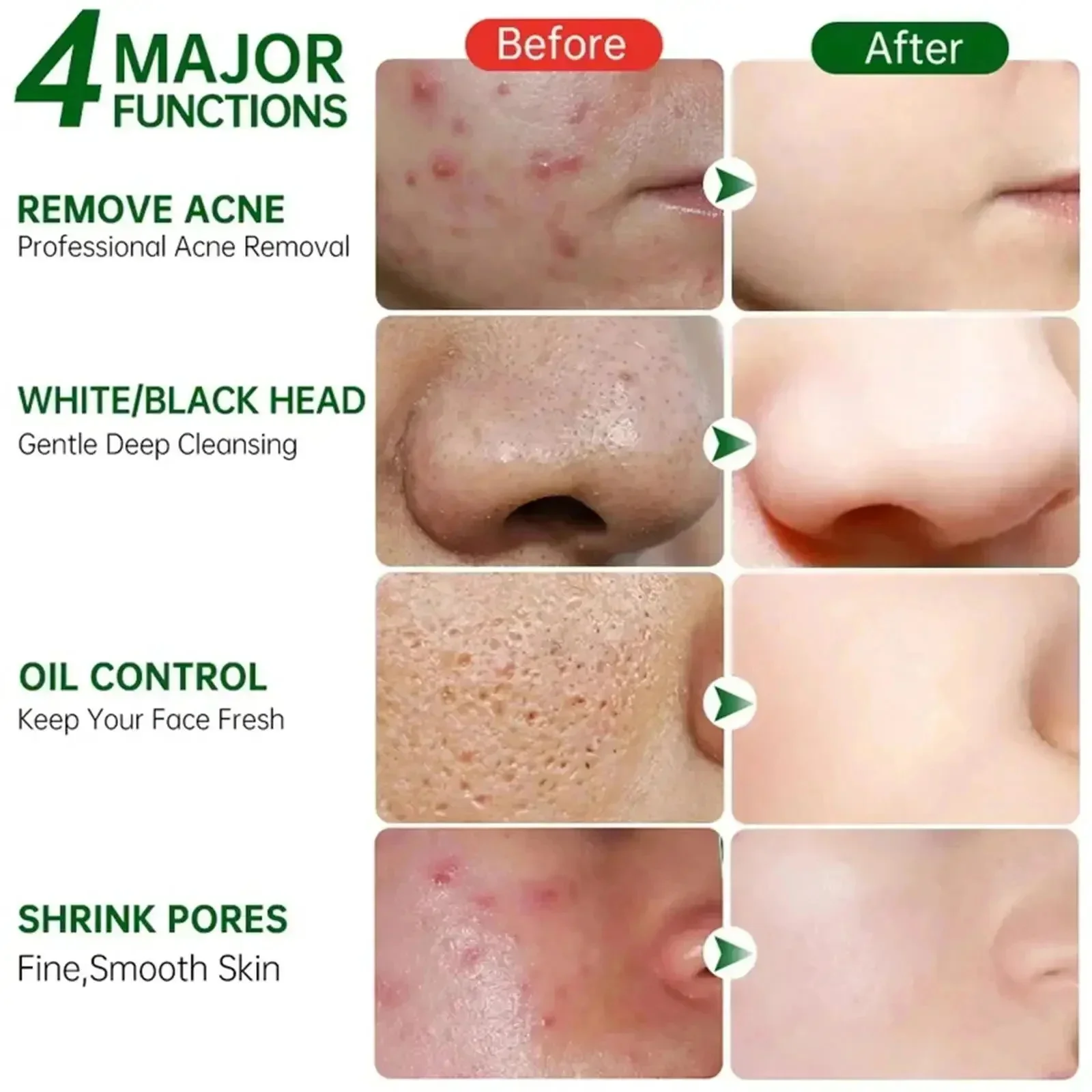 Salicylsäure Poren Clearing Cr – Salicylic Acid Blackhead Remover Bewertung und Preis
