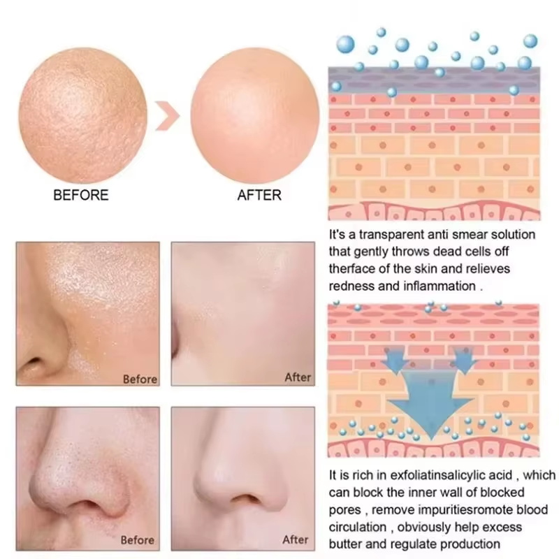 Salicylsäure Porenverkleinernd – Salicylic Acid Blackhead Remover Bewertung und Preis