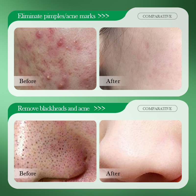 Salicylsäure Akne-Behandlungsc – Salicylic Acid Blackhead Remover Bewertung und Preis